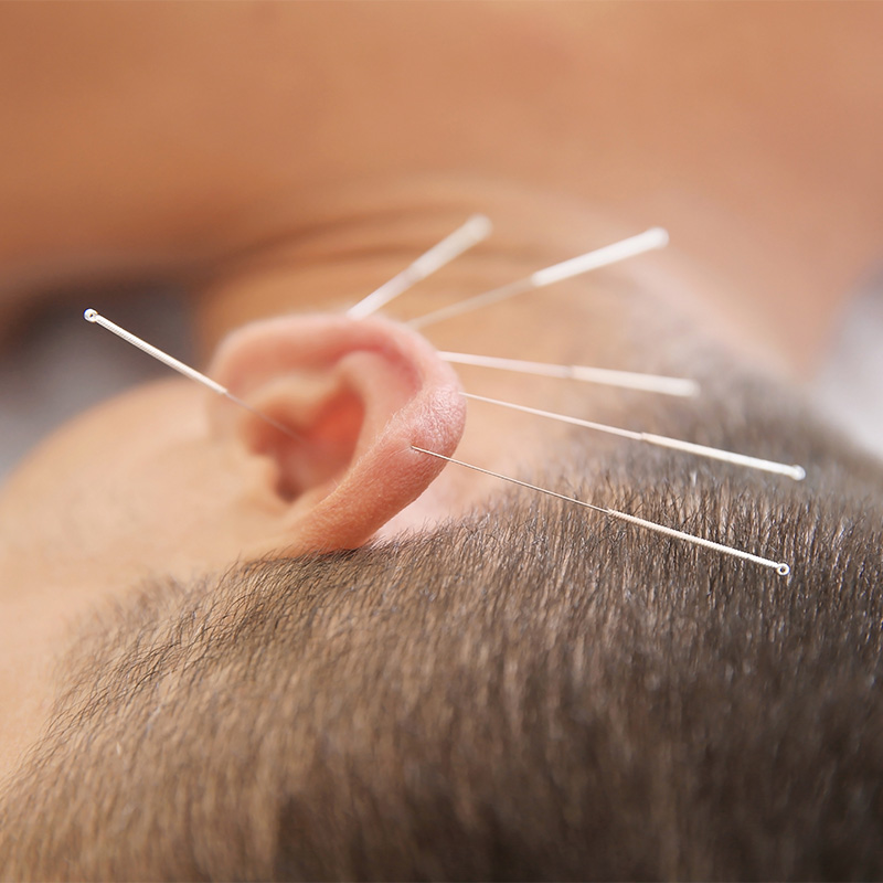 Ohrakupunktur als Folgebehandlung bei Stress, Schmerzen, Allergien oder zur Unterstützung bei Schlaf und Entwöhnung.